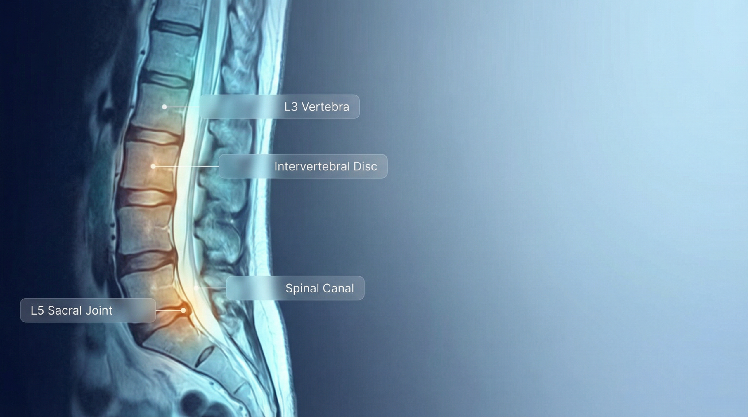 Lumbar spine MRI scan with annotated vertebrae and discs